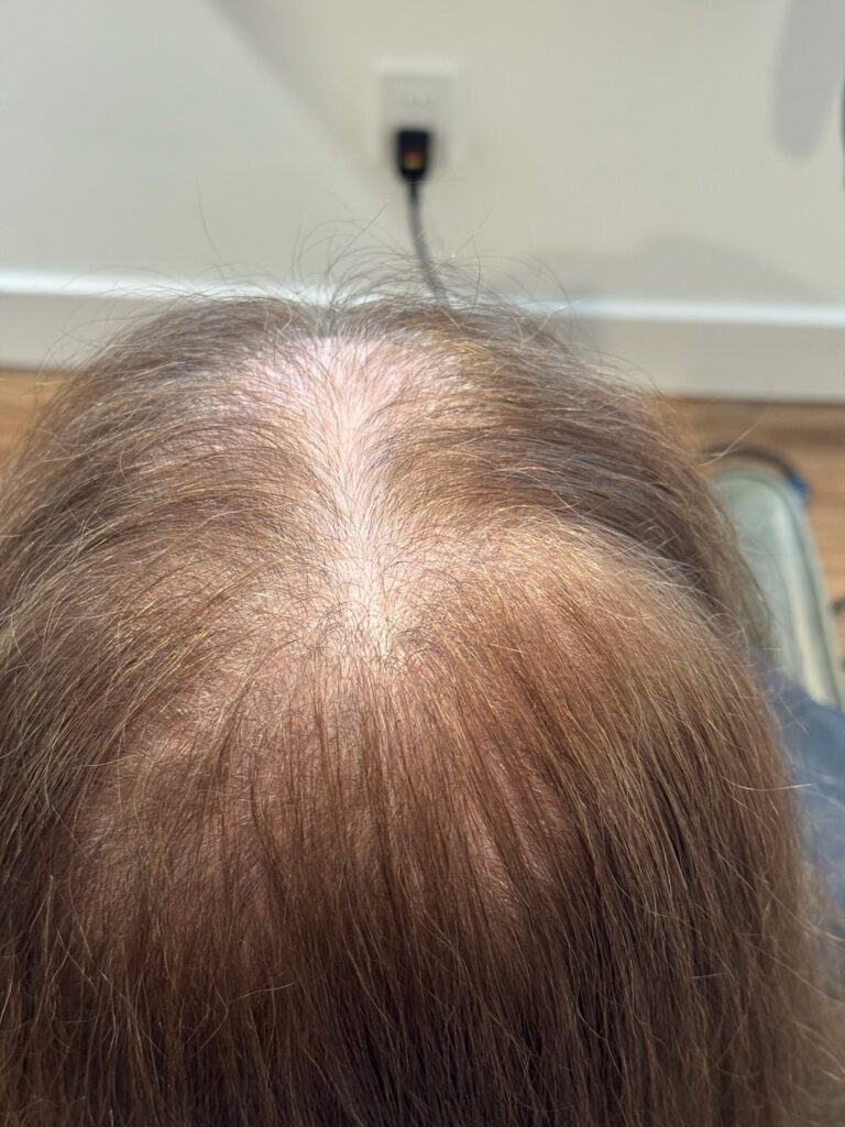 Hair Loss Solutions in St. James